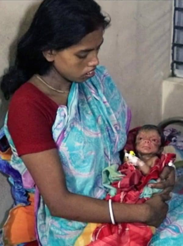 PIC FROM CATERS NEWS - (PICTURED: Parul Patro holds her newborn son who was born with Progeria. ) - A real life curious case of Benjamin Button has emerged following the birth of a baby boy who looks like an 80-year-old man. The baby was born in the district of Magura, Bangladesh, on Sunday. Local doctors, who have been left stunned, say the baby suffers from a rare condition called progeria. The baby boy has wrinkles on the face, has a very shrunken body and hollow eyes. The baby does not look like a new born at all. There are prominent sings of ageing such a excessive wrinkles and rough skin texture, said a doctor who has been treating the baby. However, the parents of the baby are jubilant with the birth of their miracle child. SEE CATERS COPY.